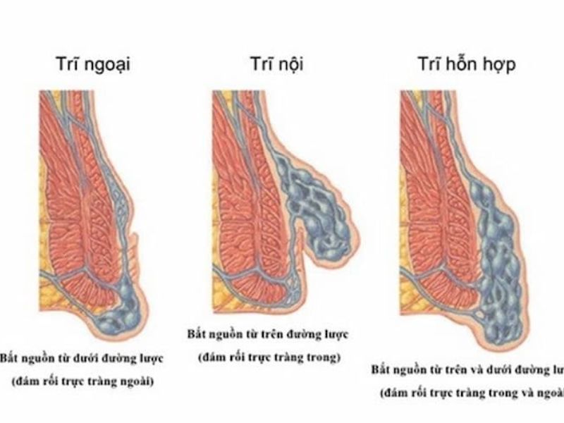 Tổng quan về bệnh trĩ ngoại