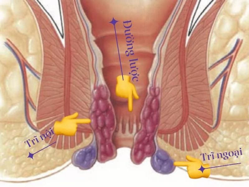 Nguyên nhân gây ra bệnh trĩ ngoại