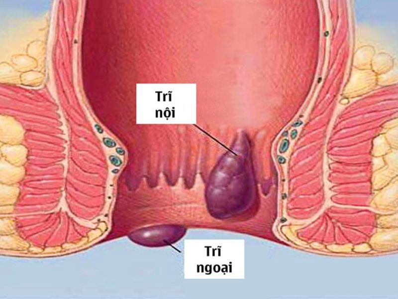 Bệnh trĩ nhẹ là gì?