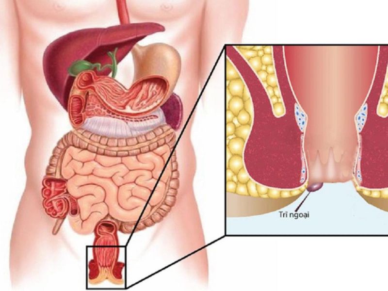 Uống gì để co búi trĩ?