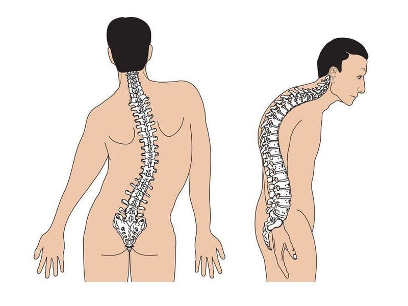 Hội chứng xương hóa đá là gì?